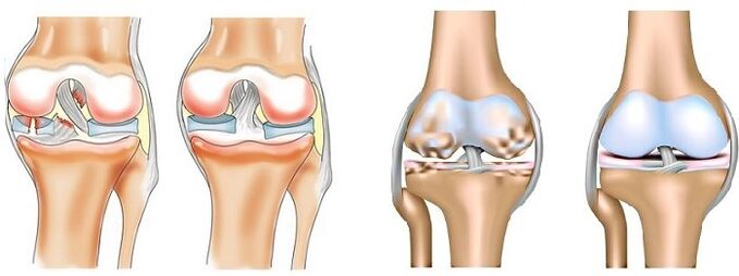 What is arthritis and arthritis 